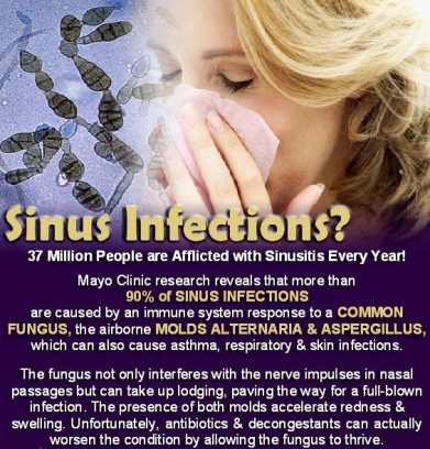 fungal infection of sinuses