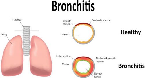what causes bronchitis